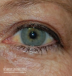 eye lift after picture